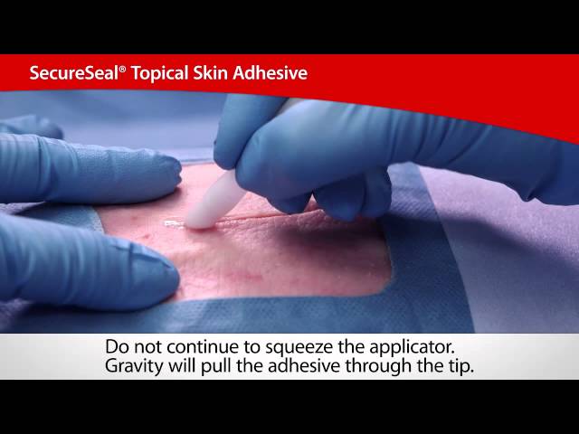 SecureSeal® Topical Skin Adhesive
