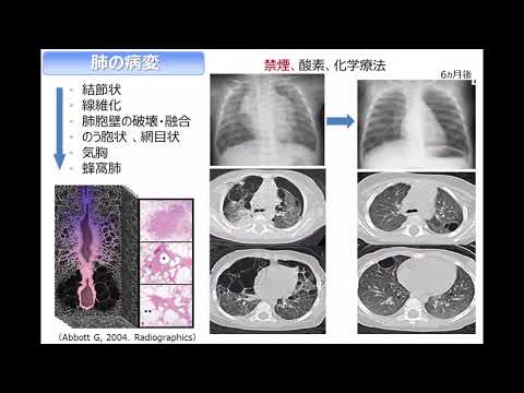 【Japan Cancer Forum2018】小児がん（組織球症・小児腎腫瘍・横紋筋肉腫）