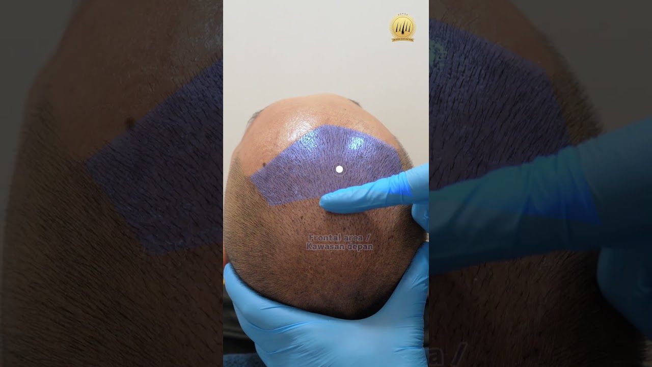 Hair Transplant Malaysia | Tanam Rambut Hari Ke-7: Selesai Mega Session! 🌱 #hairtransplantmalaysia