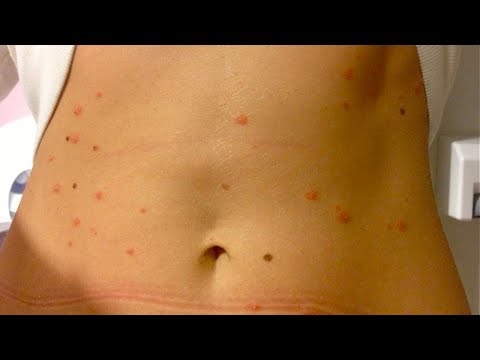 What is guttate psoriasis: pictures, symptoms, stages, photos and images