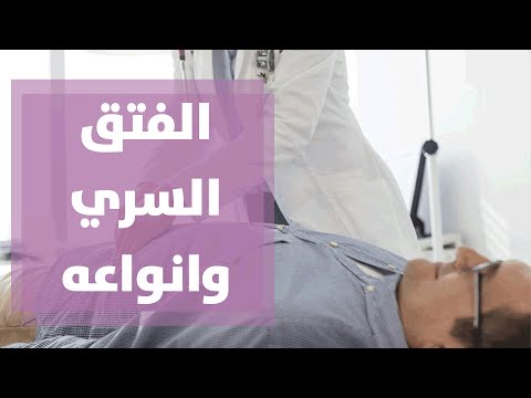 الفتق السري وانواعه