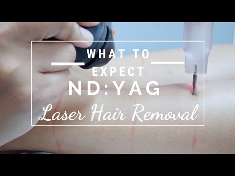 Hair reduction in a patient after 2 sessions of NdYAG laser hair removal   Download Scientific Diagram