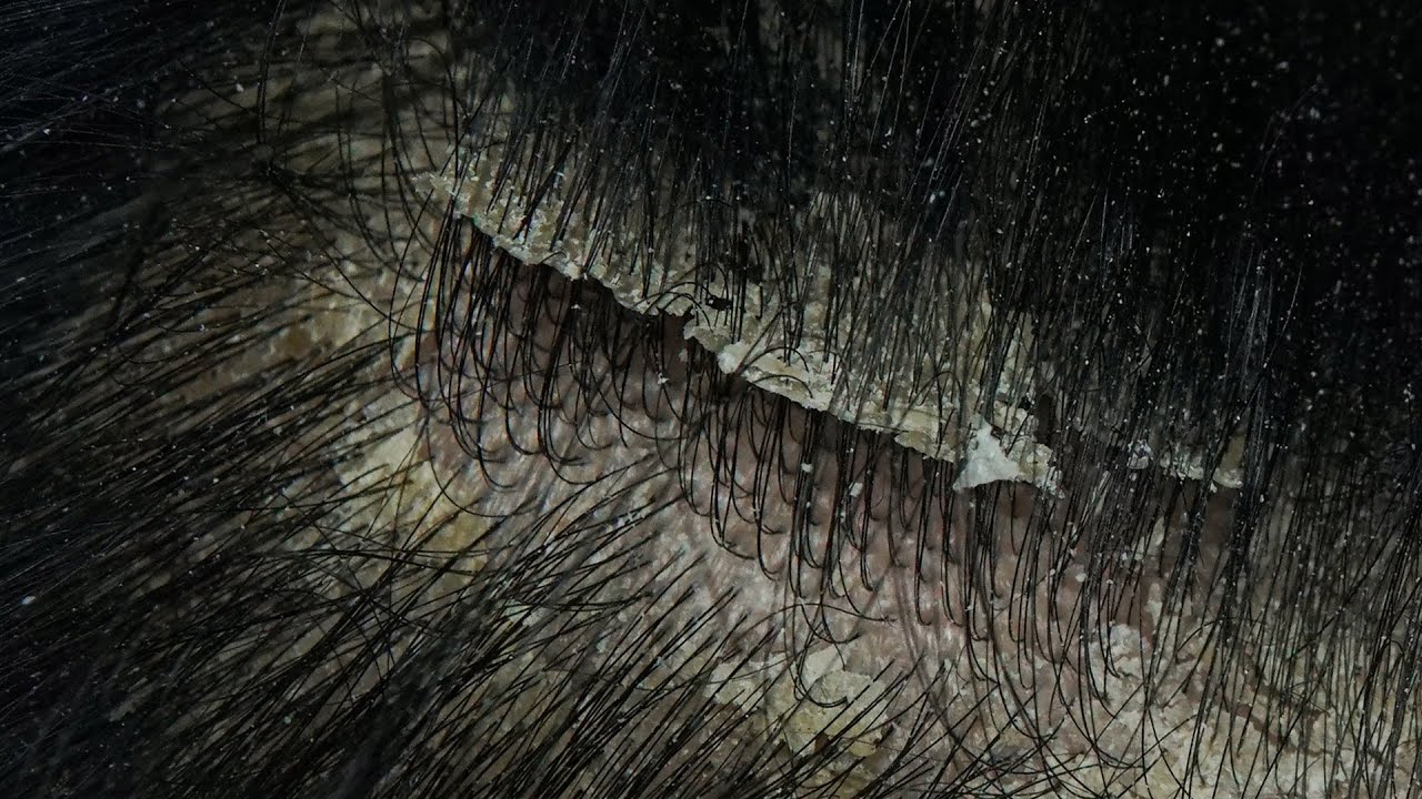 ASMR Satisfying Scalp Care: Cleaning Dandruff with Comb and Brush #36