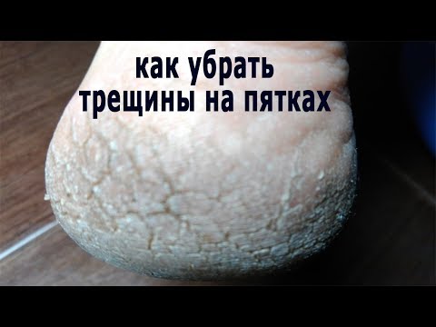 ★Пятки как у младенца. Простой рецепт убрать трещины на пятках.