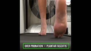 Flat feet or overpronation causes plantar fasciitis
