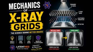 Mechanics of X-Ray Grids | How Grids Improve X-Ray Image Quality 🩻