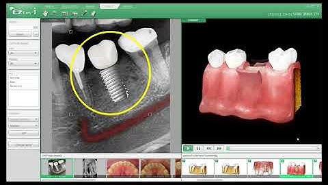 EzDent i Software from Vatech