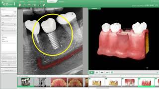 EzDent i Software from Vatech