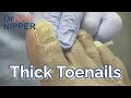 What causes thick toenails? No Thick Toenails Here... Keep Moving (2022)