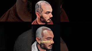 Best Hair Transplant Before and After in Turkey #hairtransformation #hairtransplant #beforeandafter