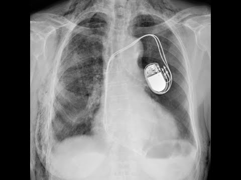 Viața cu stimulator cardiac (pacemaker). Răspunsuri la cele mai frecvente întrebări.