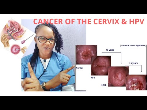 CANCER OF THE CERVIX & HUMAN PAPILLOMA VIRUS (HPV)