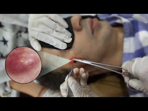 Excision Of Sebaceous Cyst From Face