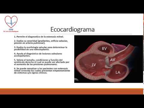 Vídeo: Estenosis Mitral: Síntomas, Grados, Tratamiento