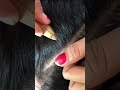 #fypviralシ #statisfying #lice #hair #LiceOnHead #liceremoval  #brasil #xyzbcafyp #licecomb  #kutu