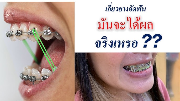 ทำไมหมอต้องให้คล้องยางจัดฟัน ดึงยางจัดฟันยังไงต้องดูคลิปนี้ - Youtube