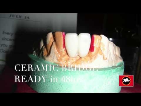 best-dental-implant-centre-in-chennai--missing-front-tooth-replacement-with-implants
