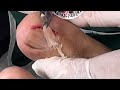 Ep_6638 Foot nails skin removal 👣 ผมเป็นบ่อย ไม่หายครับ 😄 (clip from Thailand)