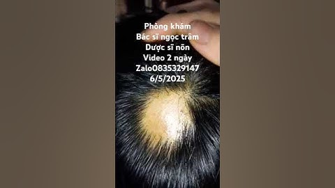 rụng tóc mảng.bé tuấn vũ.video 2 ngày