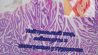 Видео Нейтральный жир, лейкоциты в копограмме у грудничка (автор: Gastro Video)