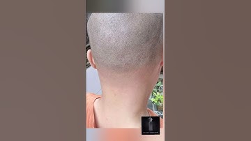 Scalp Micropigmentation FUE SCAR CAMOUFLAGING