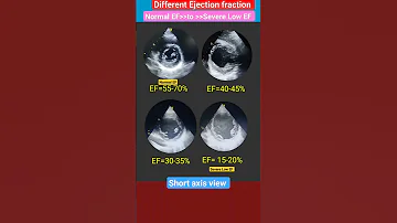 Normal To Severe Low Ejection Fraction Echo L EF 15 20 Echo Heartattack Shorts 
