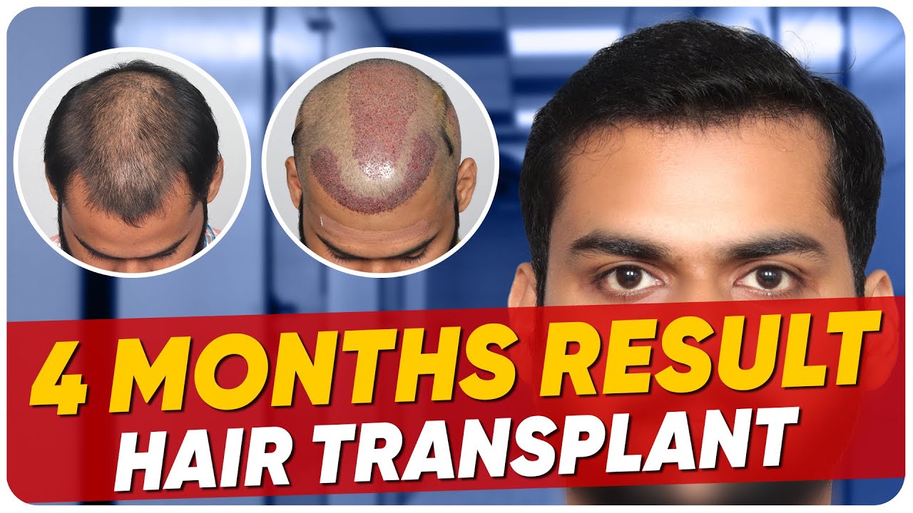 Hair Transplant in Kerala Best Results & Cost of Hair Transplant in Kerala YouTube