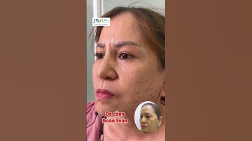 CĂNG DA MẶT SMAS PRO phương pháp thần kì HÔ BIẾN quý cô U50 cải lão hồi xuân 20 tuổi