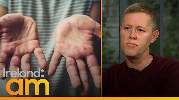 What is the Monkeypox virus? Virologist Gerald Bar...