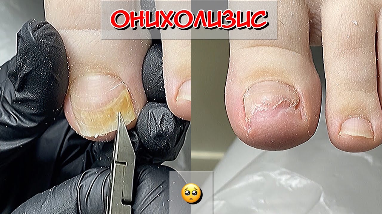 Онихолизис / зачистка / подология - YouTube