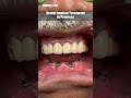 Dental Implant Procedure| Before and After #smilemakeover - #dentalimplants #dentalimplant #shorts