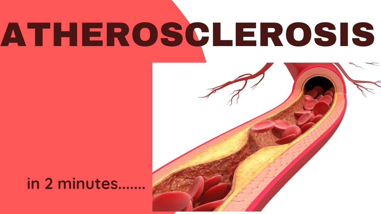 atherosclerosis-medical-vector-illustration-cross-section-diagram-unhealthy-blood-vessel