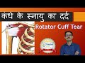 कंधे के स्नायु का दर्द Rotator Cuff Tear  hindi