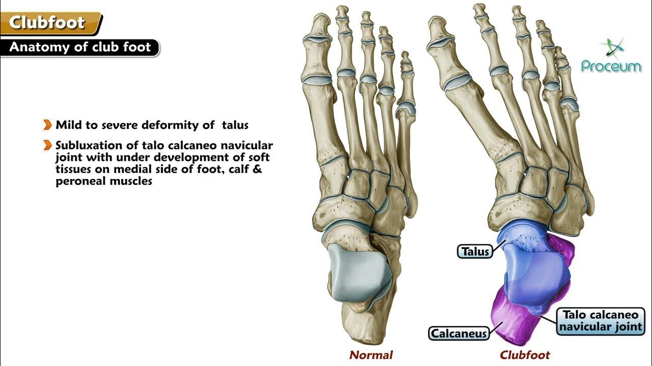Club Foot Congenital Talipes Equinovarus Talipes Equinus Talipes