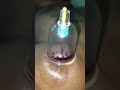 🔥Hijama Cupping therapy treatment🛃| For chronic pain 🙇🏻♂️| Wet cupping| #cupping #hijama #tamil |