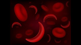 World Sickle Cell Day| KEMRI