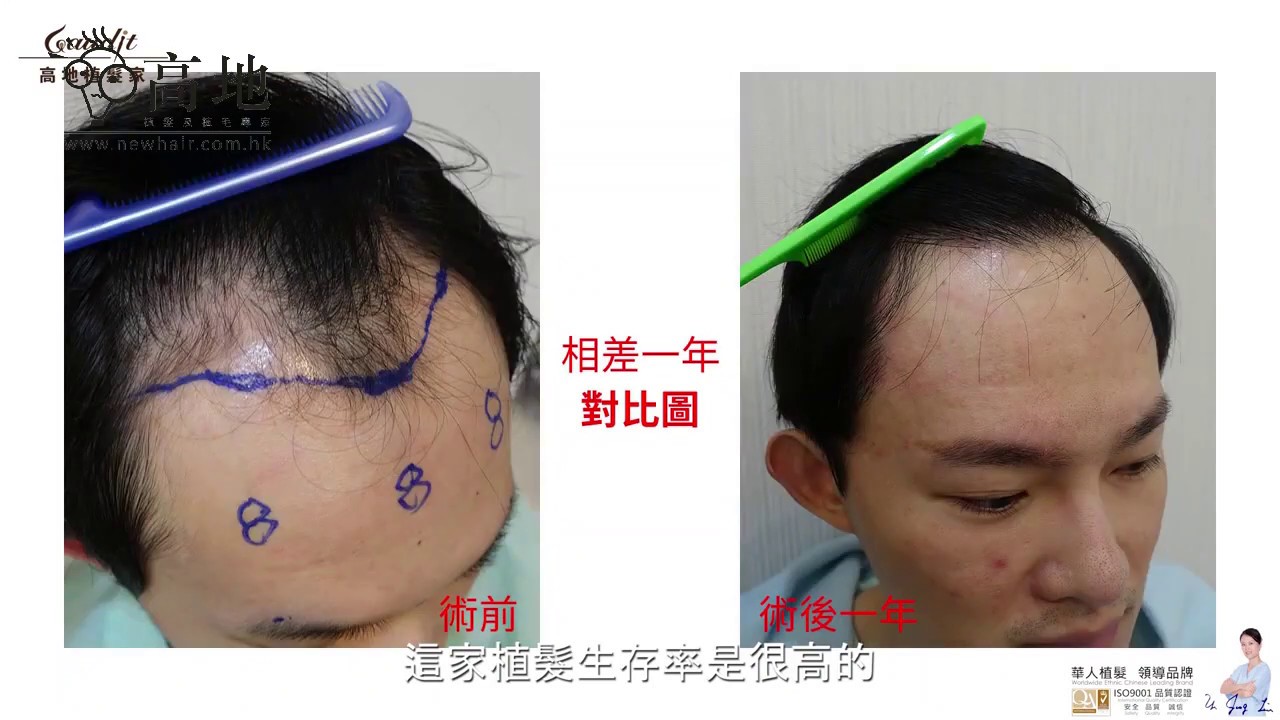 植髮成功案例飯店小生消失的髮際線 重新復活為求門面戴假髮 Youtube 植髮成功案例飯店小生消失的髮際線 重新復活為求門面戴假髮 Youtube
