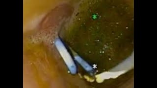 FLORIDA LIVE ENDOSCOPY (Aug 22-24, 2024) EDUCATIONAL VIDEO: EUS-GUIDED DRAINAGE OF PELVIC ABSCESS