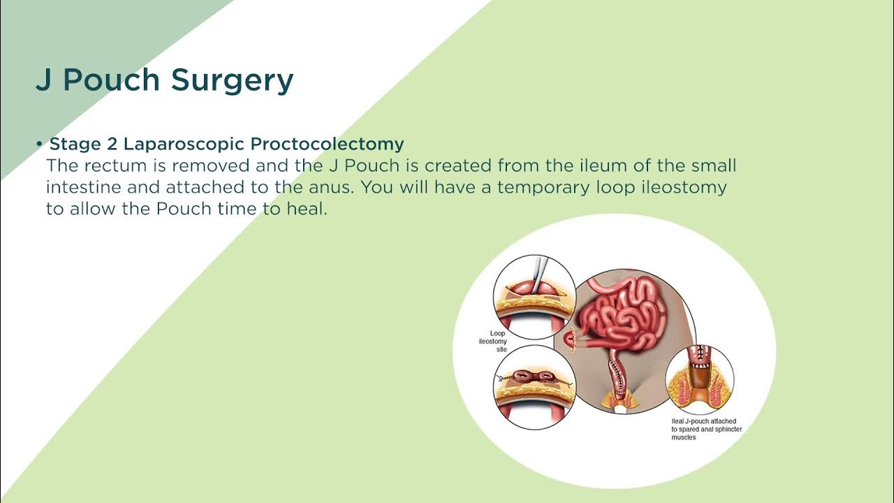 J Pouch Surgery YouTube