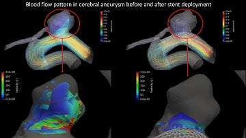 Stent deployment effects on blood flow in cerebral aneurysms