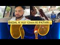 BADAL K HUI 12mm KI PATHRI 😮😱 || FIR AYURVEDIC DAVAI LANE POCHE 🏥