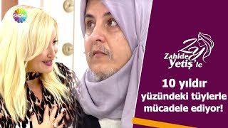 10 yıldır yüzündeki tüylerle mücadele ediyor!