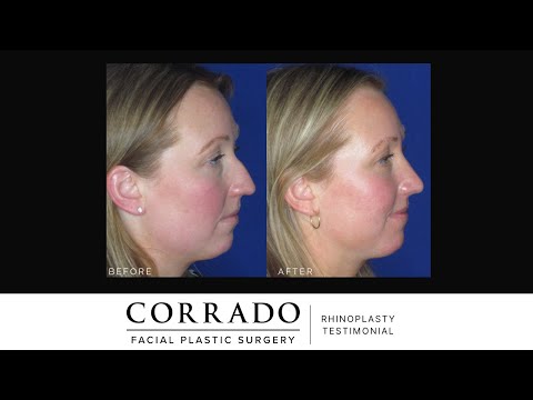 Video thumbnail: Rhinoplasty & Septoplasty Testimonial: "I Feel More Like Myself!" | Dr. Anthony Corrado · Dr. Anthony Corrado