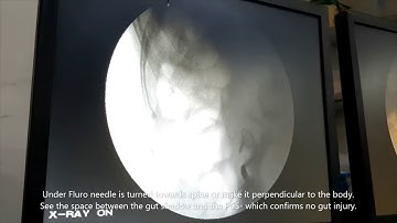 Prevent Colon or Gut Injury during PCNL, Dr Raj Kumar Sharma