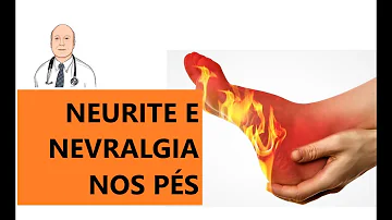 Que remédio é bom para queimação nos pés?