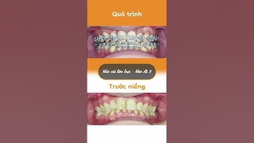 Hành trình LỘT XÁC nhờ niềng răng của Thái Thiện