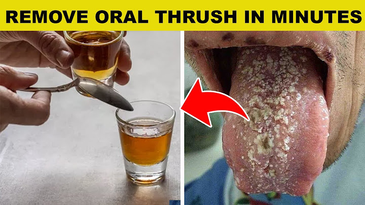 Home remedies to get rid of oral thrush
