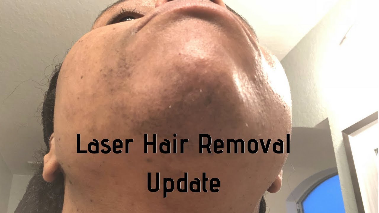 Has Laser Hair Removal Worked Dark Skin Yag Laser Youtube