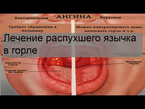 Лечение распухшего язычка в горле