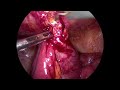 Small Bowel Obstruction due to Post Operative Adhesions: laparoscopic approach